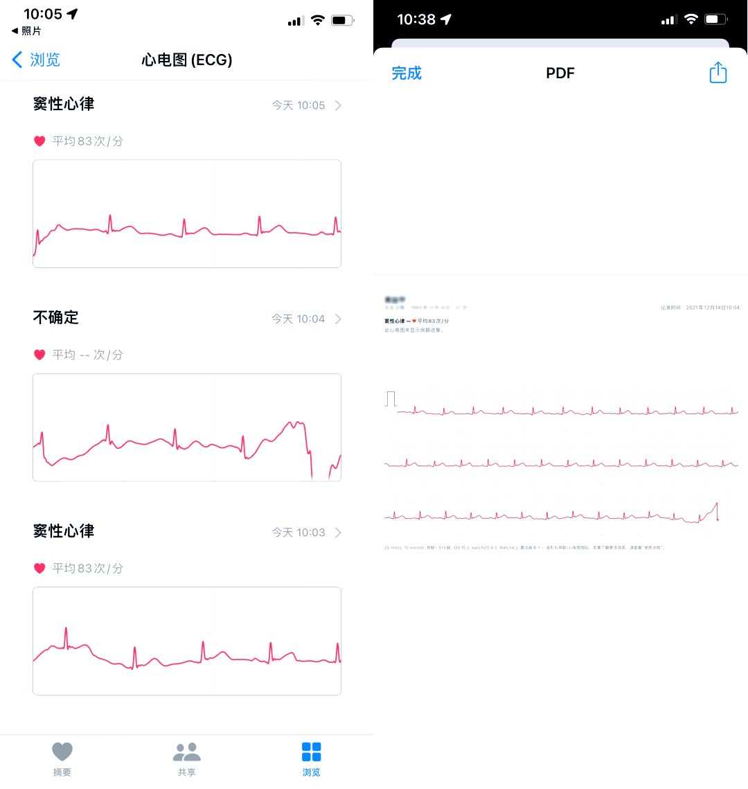 Apple Watch 心电图记录